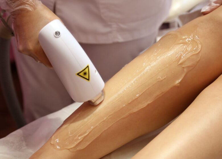 epilazione laser